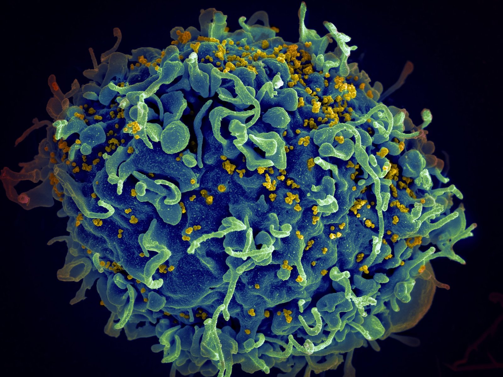 A magnified image shows a T cell (a type of immune cell) infected with HIV. The cell is colored predominantly in blue and green, with the surface covered in yellow virus particles. The background is dark, emphasizing the texture and structure of the cell and viruses.